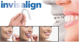 invisalign villages fl