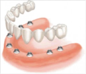 IMPLANT DENTISTRY