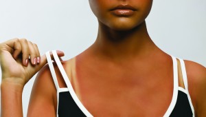 Sunburn-  What is it and How to Avoid it