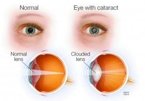 Clear Facts About Cataracts