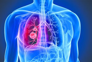 InterCommunity Cancer Center Promotes  Lung Cancer Awareness Month By Recommending  Screening For People At High Risk