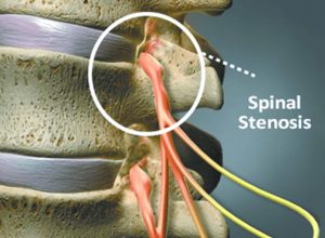 Think Surgery is the Only Way to Treat Spinal Stenosis? Think Again.