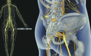 Don’t Let Sciatic Nerve Pain  Get in the Way of Your Life