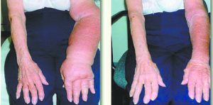 WHAT IS LYMPHEDEMA?