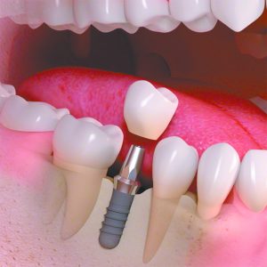Avoiding Oral Pain