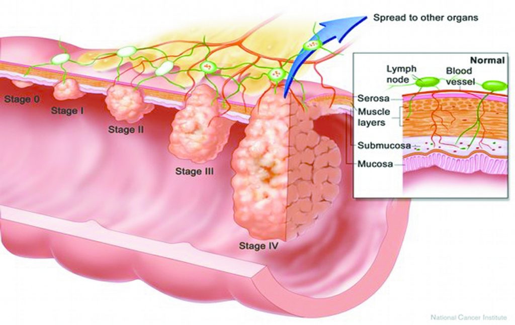 Early Detection of Colorectal Cancer Saves Lives