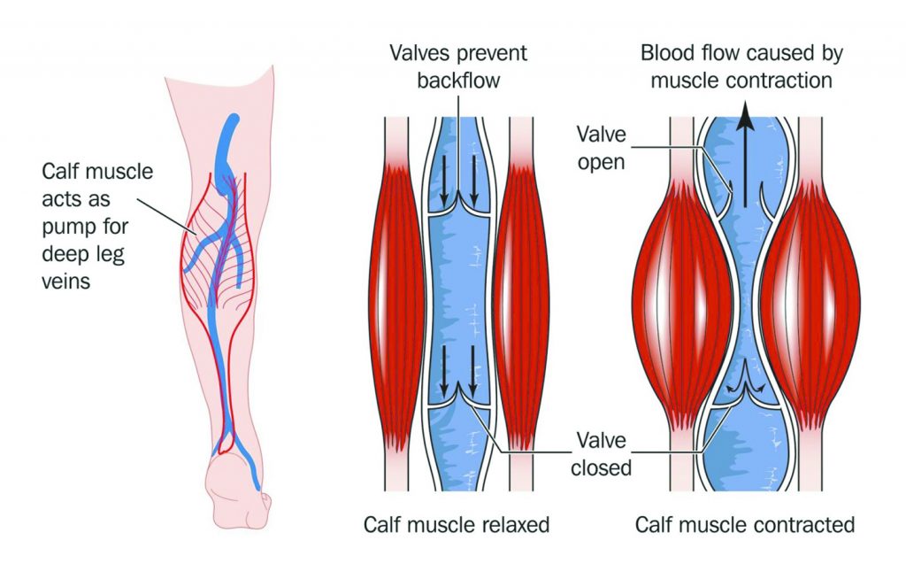 The Overlooked Dangers of Venous Insufficiency