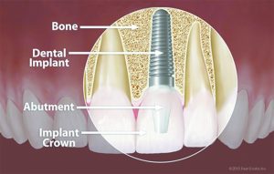 Am I a Candidate for Dental Implants?