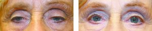 BLEPHAROPLASTY