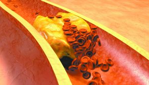 The Link Between High Cholesterol