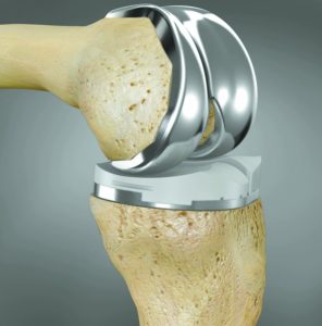 A Knee Replacement Implant Made Specifically For You