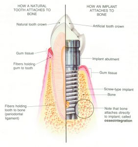 Am I a Candidate for Dental Implants