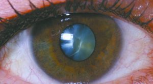 Get to Know Your Eye Lens Implant Options