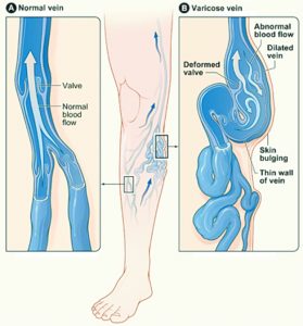 Leg Swelling Causes and Concerns