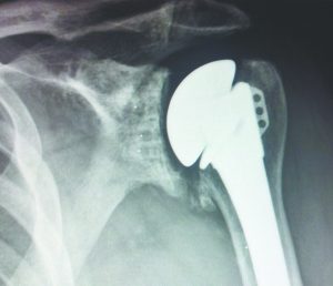 Shoulder Joint Replacement Groundbreaking Procedures from The Advanced Orthopedic Institute