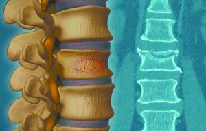 What if Your Back Pain is a Spine Compression Fracture?