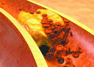 High Cholesterol = High Risk for Debilitating Diseases