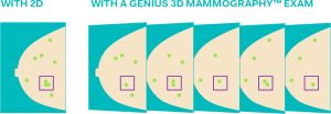2D vs. 3D Mammography What’s the Difference?
