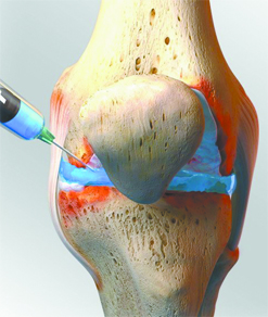 AN INNOVATIVE RESEARCH STUDY FOR TREATMENT OF KNEE OSTEOARTHRITIS IS BEING CONDUCTED BY THE FLORIDA HOSPITAL ORTHOPAEDIC RESEARCH TEAM