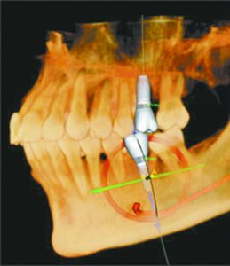 3D Imaging Minimizes Time and Cost of Dental Procedures