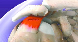 Surgical and Nonsurgical Treatments  for Rotator Cuff Injuries