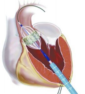 Photo Credit: https://ctsurgerypatients.org/news/ 2015/09/transcatheter-aortic-valve- replacement-is-safe-effective-for- very-elderly-patients
