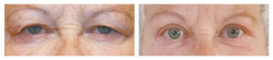  Drooping Eyelids Diminishing Vision and Appearance