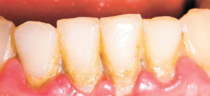 Dental Plaque & Periodontal Disease  Can Affect Your Overall Health