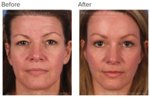 Nonsurgical Facelifting: Major Facial Rejuvenation without Surgery 