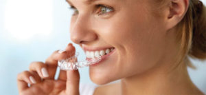 Clear Aligners Vs. Traditional  Orthodontic Braces