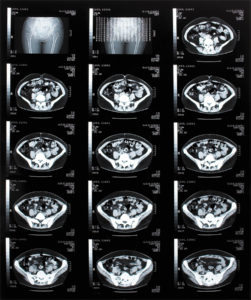 Computed Tomography  of the Abdomen/Pelvis