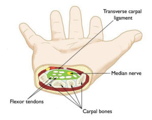What is Carpal Tunnel Syndrome (CTS)?