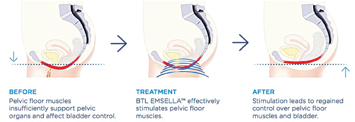 Introducing the Emsella Chair… The Latest Breakthrough Treatment for ...