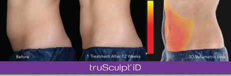 Start TruSculpt Body Contouring Now for the Shape You've Always Wanted by  Summer: Dermatology of Boca: Dermatologists