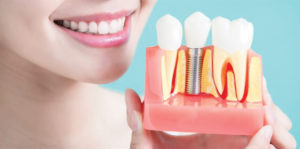Are Your Dentures Driving You Crazy? Consider Implant Over-Dentures 