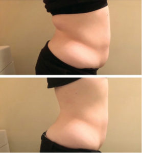 The Strawberry  Inch-Loss Laser:  Your Answer to  Losing Inches