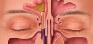 ENT Specialist Dr. Michael Branch’s  Approach for Chronic Sinus Infection