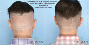 What Happens After  a Hair Transplant?