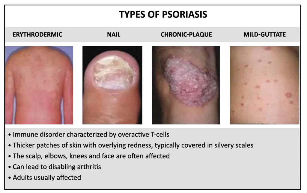 August is psoriasis awareness month