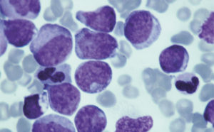 Leukemia