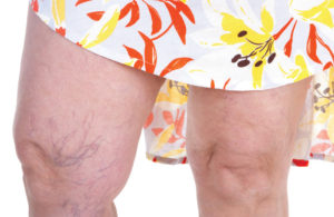 Spider Veins Treatment and Causes