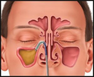 Chronic Sinus Infections?  What Do ENT Specialists Recommend?
