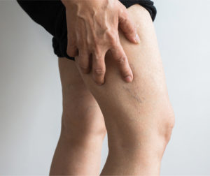 Is the Pain in Your Legs or Bulging  Veins a Warning Indicator? What You Should Know