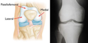 Partial Knee Replacement