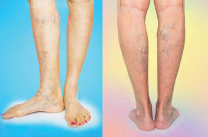 Varicose and Spider Veins Are Not Always Superficial