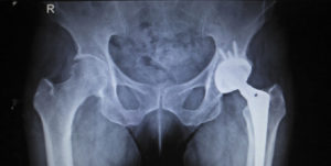 OPIOD FREE ANESTHESIA for OUTPATIENT TOTAL HIP AND TOTAL KNEE REPLACEMENT