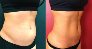 Revolutionary treatment to build muscle while shrinking fat