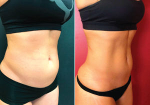 Revolutionary treatment  to build muscle while  shrinking fat