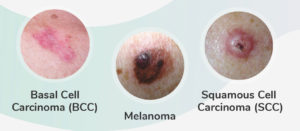 MELANOMA SKIN CANCER