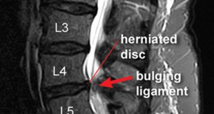 Painful Disc Herniations